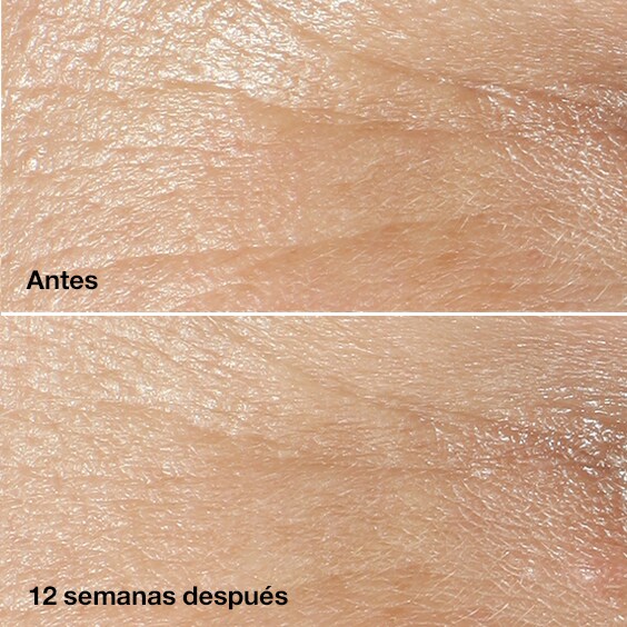 Antes. Después de 12 semanas.*